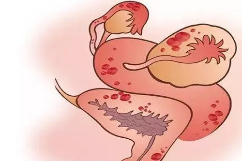 一篇文章带你了解盆腔炎