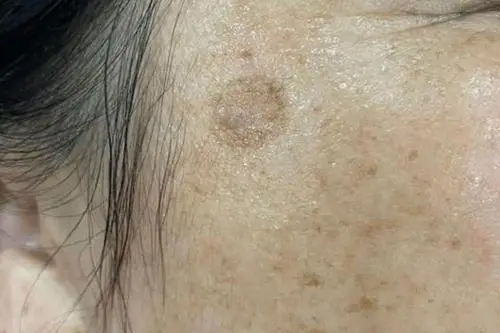 子宫肌瘤会长斑吗