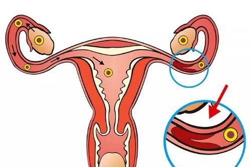 子宫内膜异位症引起的原因