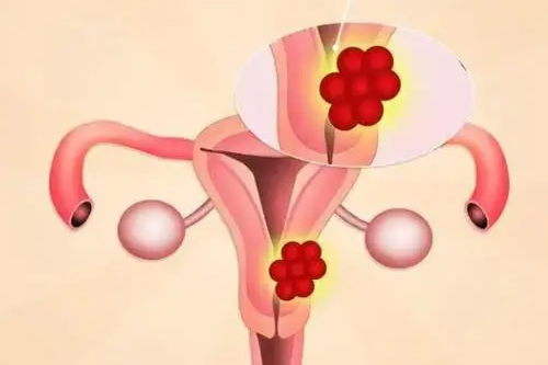 盆腔炎主要病因是什么