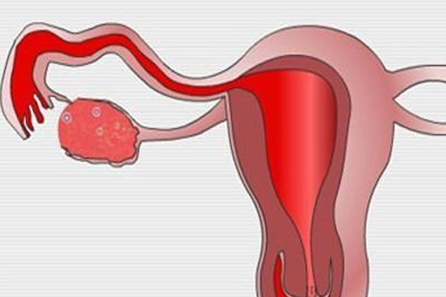 输卵管性不孕是什么原因引起有哪些