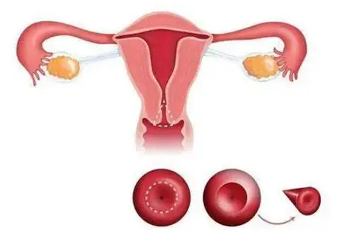 子宫内膜异位症产生的原因